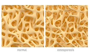 osteoporosis bone and healthy bone