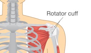 diagram of Rotator Cuff repair