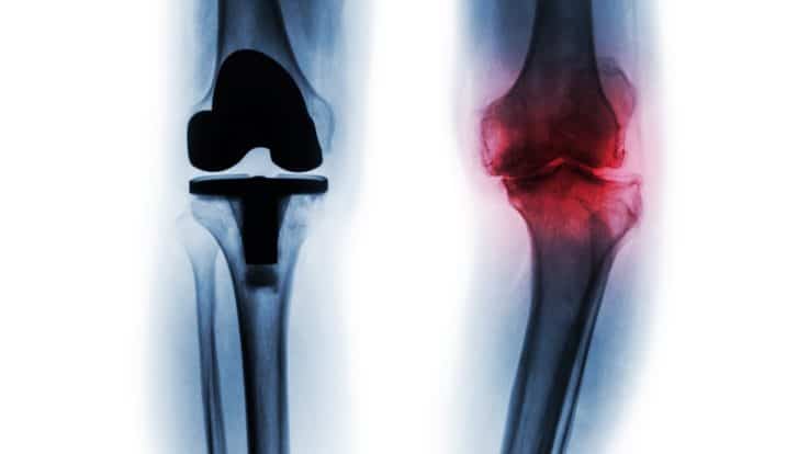 Medical Advancements and Technology in Total Knee Replacement Surgery